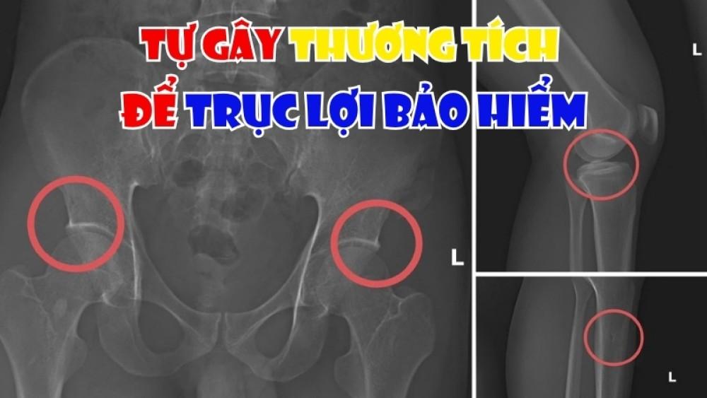 Nhân và Quả từ câu chuyện "tự gây thương tích để trục lợi bảo hiểm"